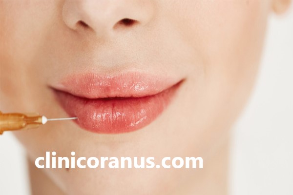 تزریق فیلر لب مدل نچرال در غرب تهران | کلینیک اورانوس