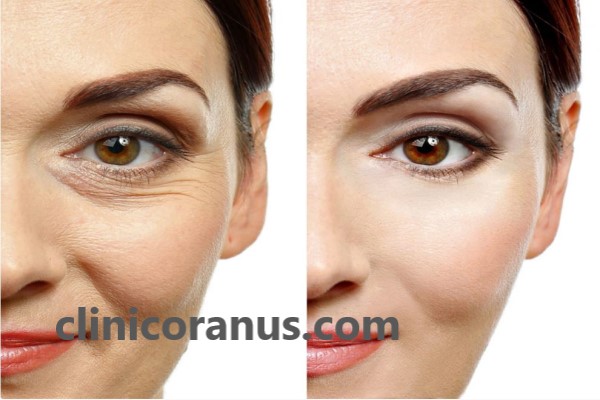 تزریق مزوژل جالپرو در بهترین کلینیک پوست | کلینیک اورانوس