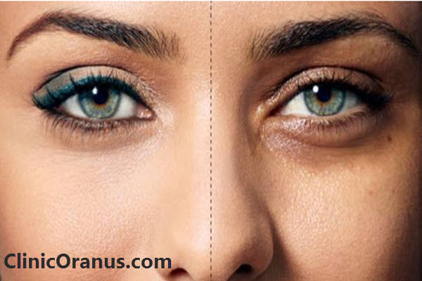 تزریق مزوژل جالپرو در تهران با مناسب ترین قیمت