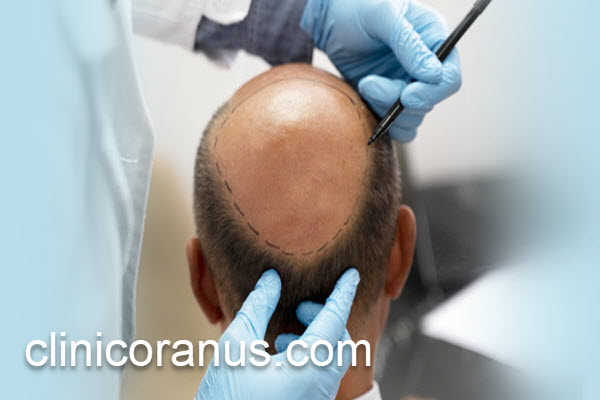 کاشت طبیعی و دائمی مو توسط بهترین متخصصان | کلینیک اورانوس