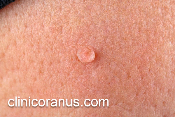 درمان بیماری ویروسی جنسی در بهترین کلینیک غرب تهران | کلینیک اورانوس