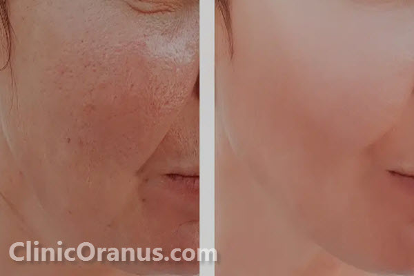 مراقبت های قبل از درمان با لیزر فرکشنال