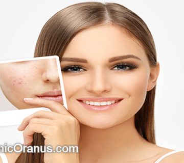 بهترین روش برای از بین بردن اسکار جوش | کلینیک اورانوس