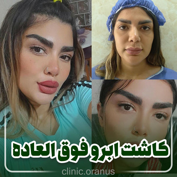 کاشت ابرو | کلینیک اورانوس