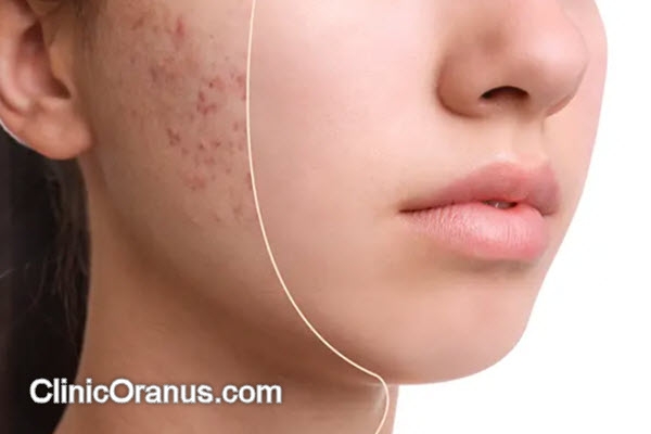 بهترین روش برای از بین بردن اسکار جوش | کلینیک اورانوس