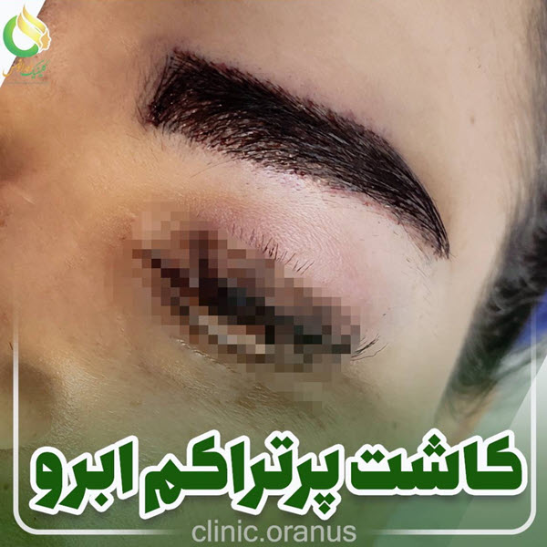 کاشت ابرو | کلینیک اورانوس