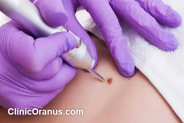 علائم زگیل تناسلی | کلینیک اورانوس