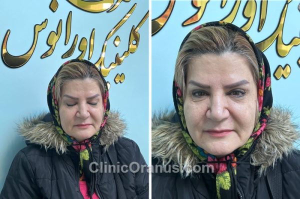 نتیجه بلفارو بعد از دو ماه | کلینیک اورانوس