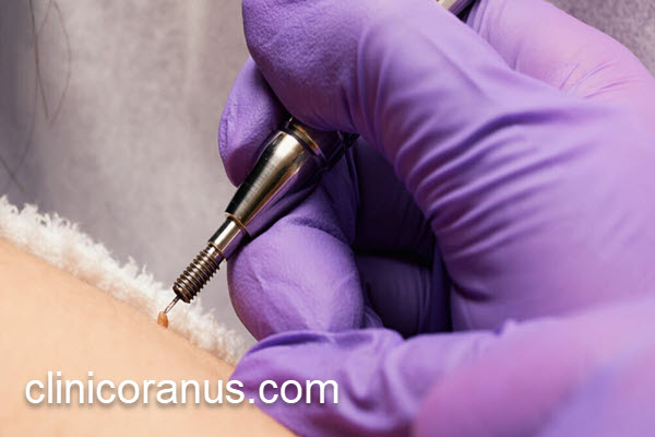 بهترین مرکز درمان زگیل تناسلی در تهران | کلینیک اورانوس