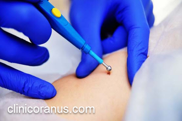 مرکز تخصصی درمان زگیل تناسلی در تهران | کلینیک اورانوس