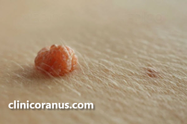 زگیل تناسلی چیست؟