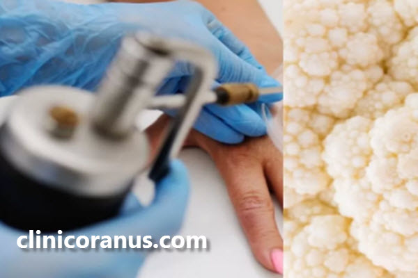 نکات قبل از درمان زگیل تناسلی با کرایوتراپی