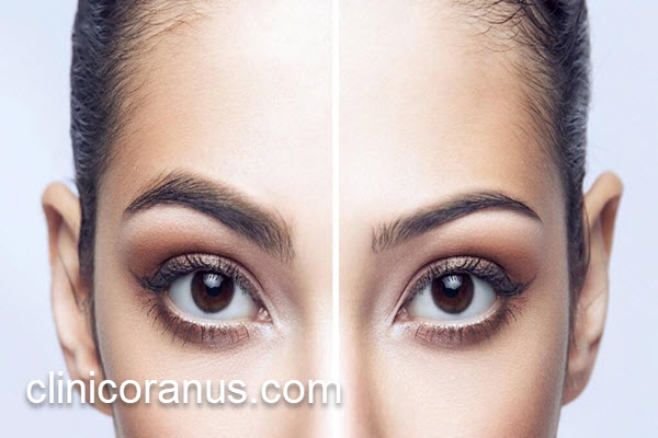 هزینه کاشت ابرو طبیعی | کلینیک اورانوس