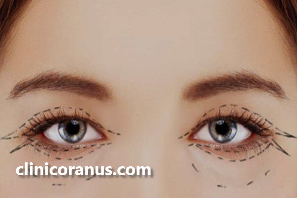 روش های بلفاروپلاستی