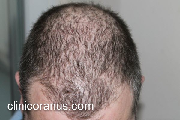 بهترین مرکز پیوند مو در جنت آباد | کلینیک اورانوس