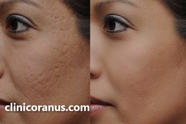 دوران نقاهت سابسیژن چقدر است؟