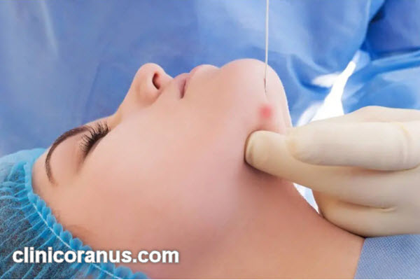 نکات مهم در انتخاب پزشک متخصص اندولیفت | کلینیک اورانوس