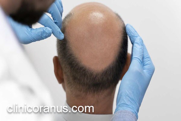 کاشت مو در کلینیک معتبر | کلینیک اورانوس