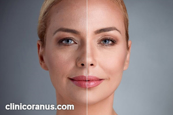 هزینه اندولیفت صورت در سال 1404 چقدر است؟ | کلینیک اورانوس