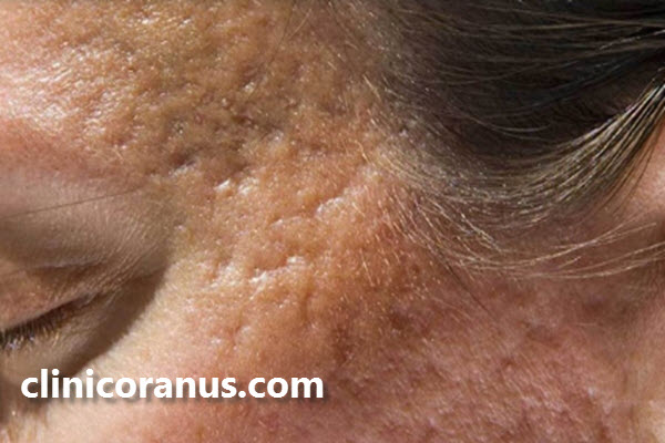 بهترین مرکز درمان جوش و اسکار در جنت آباد