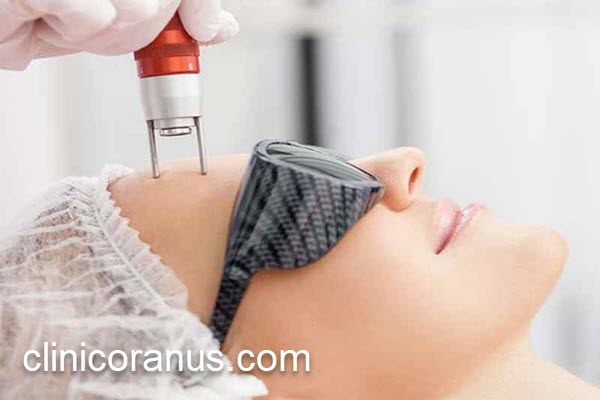 آشنایی با بهترین مرکز لیزر co2 فرکشنال | کلینیک اورانوس