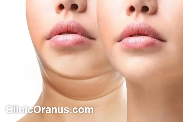 مزایای استفاده از لیپوساکشن غبغب | کلینیک اورانوس