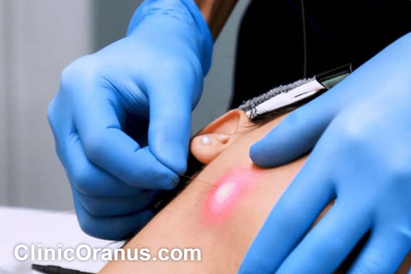 نحوه اثرگذاری اندولیفت صورت | کلینیک اورانوس