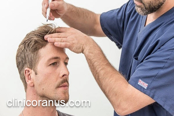 کاشت مو در بزرگترین مرکز کاشت مو | کلینیک اورانوس