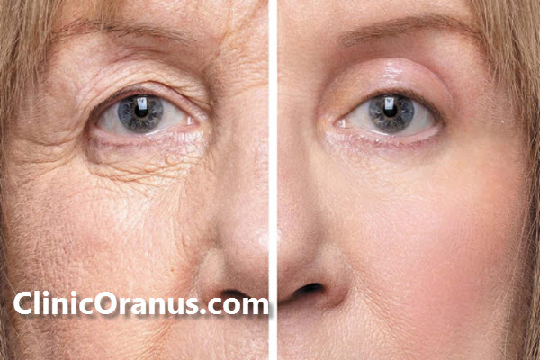 بلفاروپلاستی چیست؟ | غرب تهران