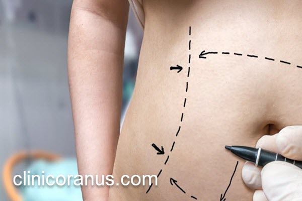 پزشک متخصص لیپوماتیک در جنت آباد | کلینیک اورانوس 