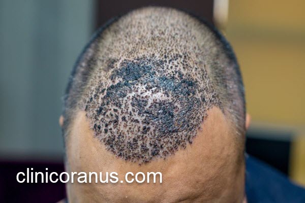 برترین کلینیک کاشت مو در تهران | کلینیک اورانوس