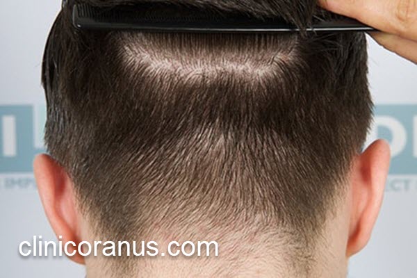 مرکز تخصصی کاشت مو در تهران | کلینیک اورانوس