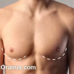 هزینه عمل ژنیکوماستی در سال 1404