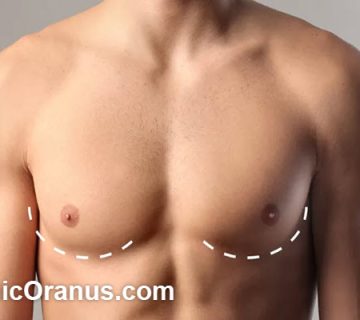 هزینه عمل ژنیکوماستی در سال 1404