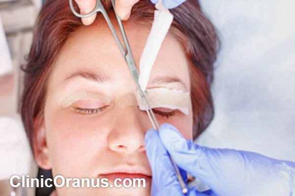 هزینه بلفاروپلاستی در تهران چقدر است؟