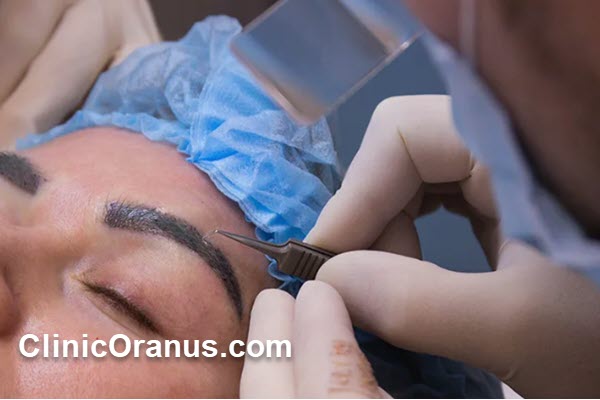 هزینه کاشت ابرو در جنت آباد چگونه محاسبه میشود؟