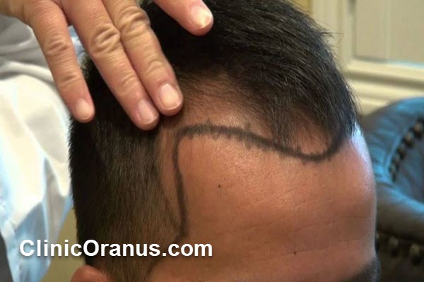 هزینه کاشت مو در جنت آباد چقدر است؟