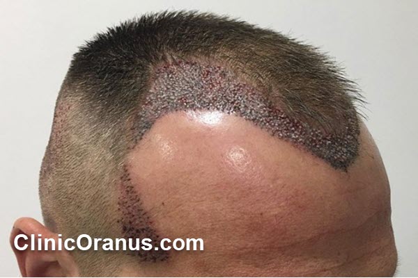 چرا کاشت مو بهترین روش درمان ریزش مو است؟