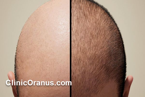 کاشت مو در جنت آباد | کلینیک اورانوس