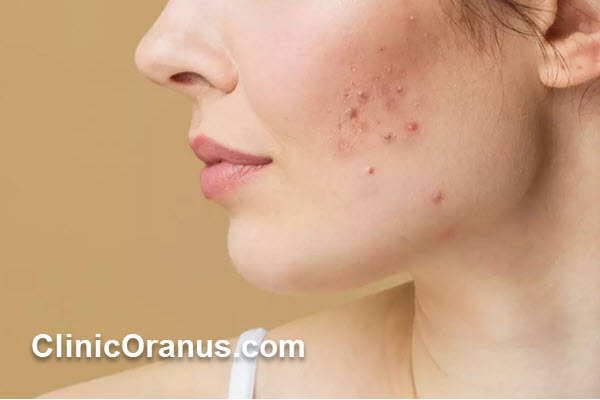 اسکار جوش چیست و چرا ایجاد میشود؟