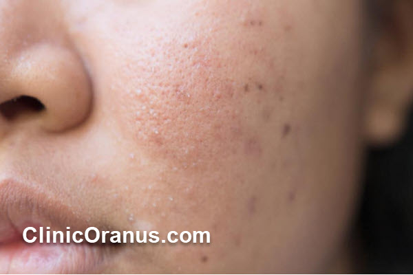 مراقبت های لازم بعد از درمان اسکارهای پوستی