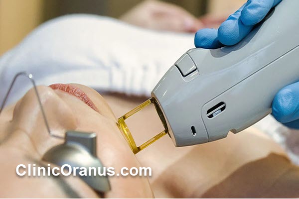 هزینه لیزر موهای زائد با دستگاه الکساندرایت کندلا