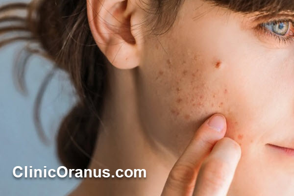 درمان قطعی اسکار جوش در غرب تهران