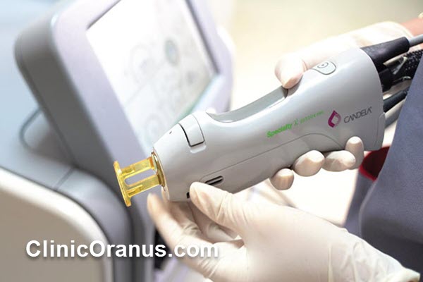 لیزر موهای زائد با دستگاه الکساندرایت کندلا در غرب تهران