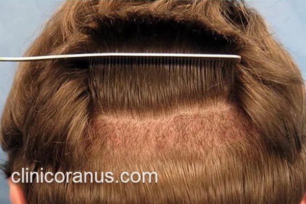 کاشت ابرو با موهای پشت سر | کلینیک اورانوس