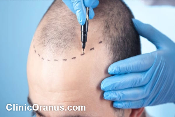 hair-transplant-in-janat-abad-tehran-clinicoranus.com کاشت مو در جنت آباد تهران