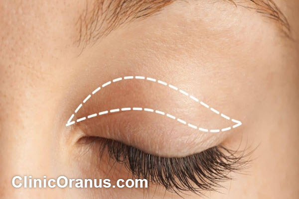 how-long-does-blepharoplasty-last-clinicoranus.com بلفاروپلاستی چقدر ماندگاری دارد؟