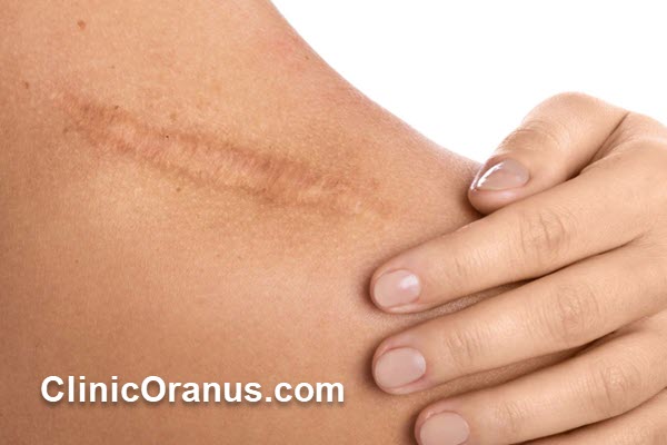 اسکار بعد از جراحی چگونه ایجاد میشود؟
