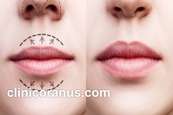 the-best-doctor-for-a-central-lip-lift-in-jannat-abad-clinicoranus.com بهترین دکتر برای لیفت سانترال لب در جنت آباد